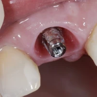 Teeth Implants 0