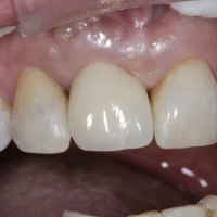 Teeth Implants 1