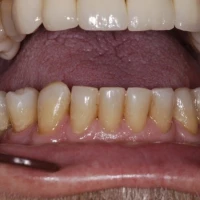 Invisalign Braces 5