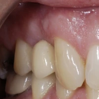 Invisalign Braces 8