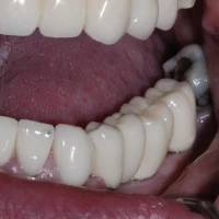 Invisalign Braces 10