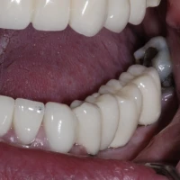 Professional Teeth Whitening 10