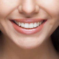 Professional Teeth Whitening 1