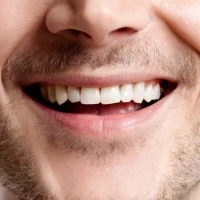 Professional Teeth Whitening 3