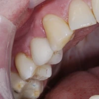 Full Teeth Implants 4