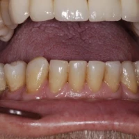 Full Teeth Implants 5