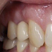 Full Teeth Implants 8