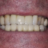 Full Teeth Implants 9
