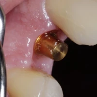 Full Teeth Implants 11