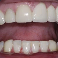 Single Tooth Implant 7