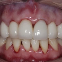 Dental Bridge Application 5