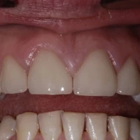 Dental Bridge Application 6