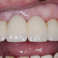 Dental Crown Replacement 4