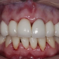 False Teeth Dentures 9